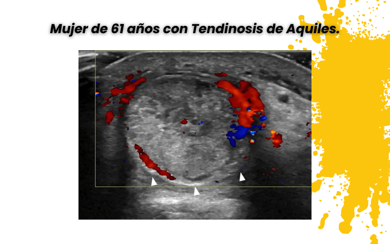 3. Tendon aquiles ecografia tempo formacion.png